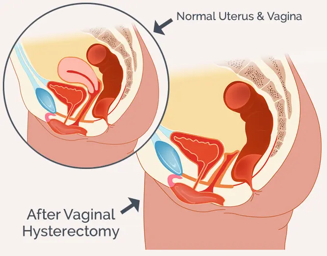 Vaginal Hysterectomy lady doctor in Kolkata